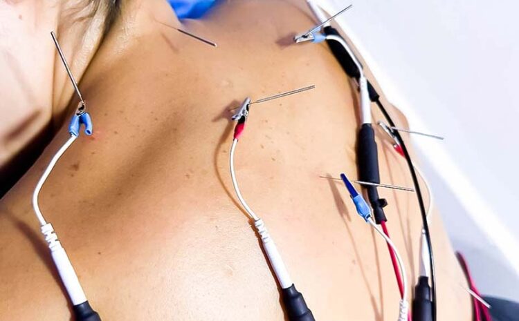 electroacupuntura1
