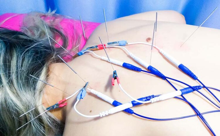 electroacupuntura4